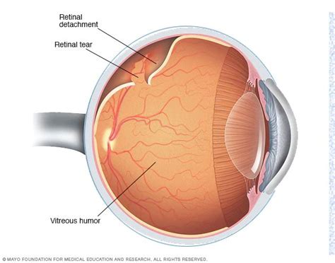 vitreous detachment mayo clinic